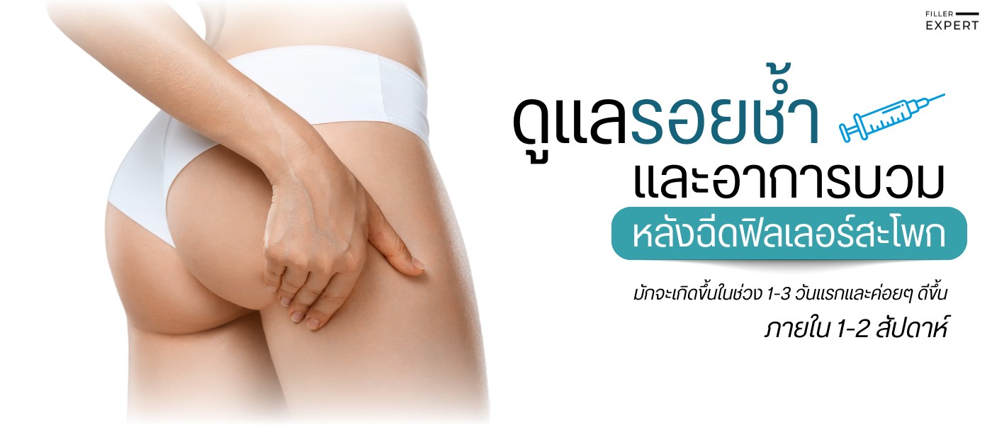 การดูแลรอยช้ำและอาการบวมหลังฉีดฟิลเลอร์สะโพก - filler-expert - rwc