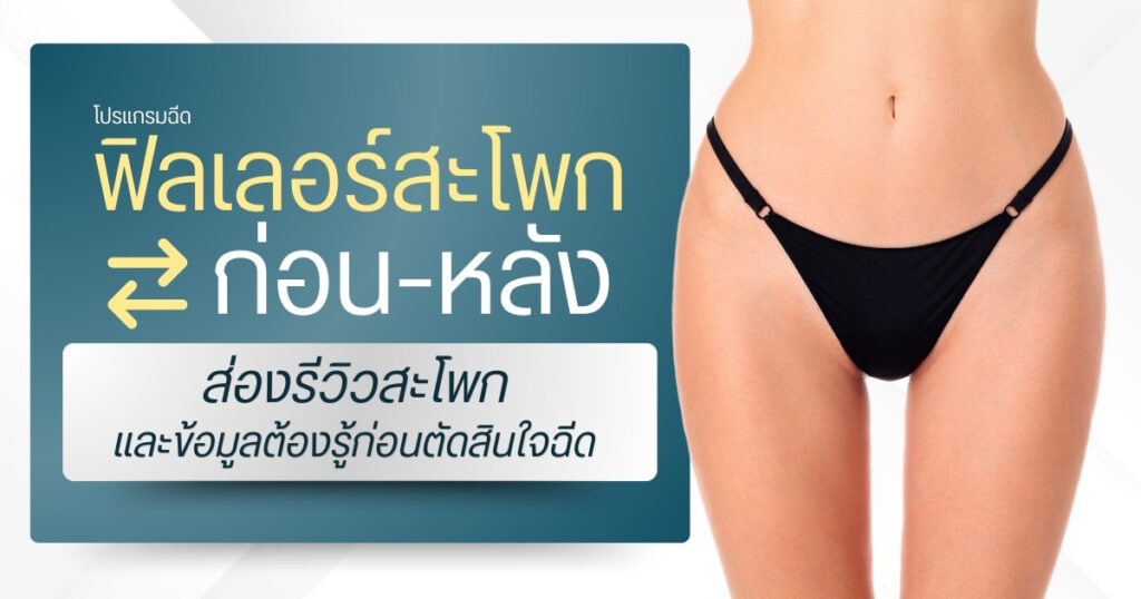 ฟิลเลอร์สะโพก ก่อนหลัง