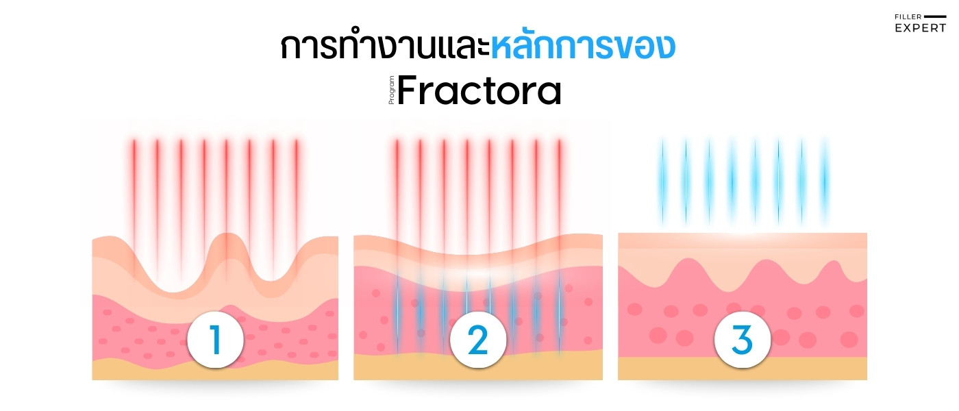 การทำงานและหลักการของ Fractora
