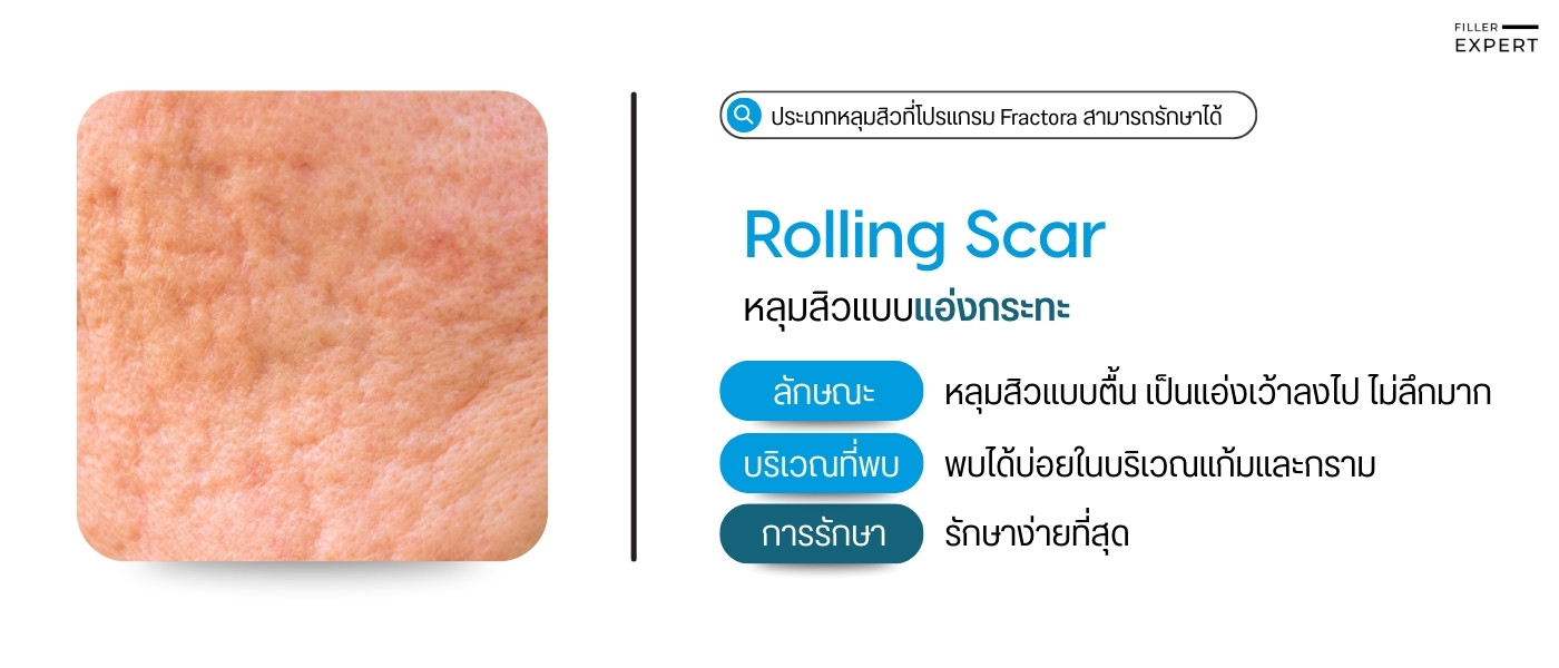 ประเภทหลุมสิวที่ Fractora สามารถรักษาได้ Rolling Scar หลุมสิวแอ่งกะทะ
