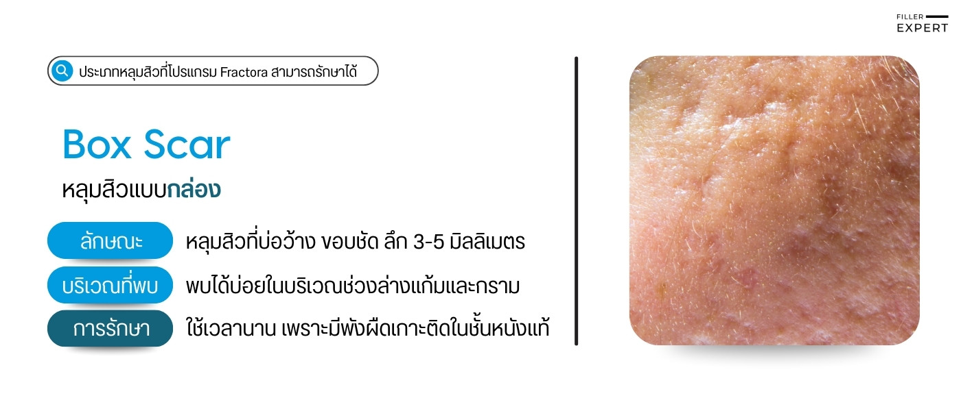 ประเภทหลุมสิวที่ Fractora สามารถรักษาได้ Box Scar หลุมสิวแบบกล่อง