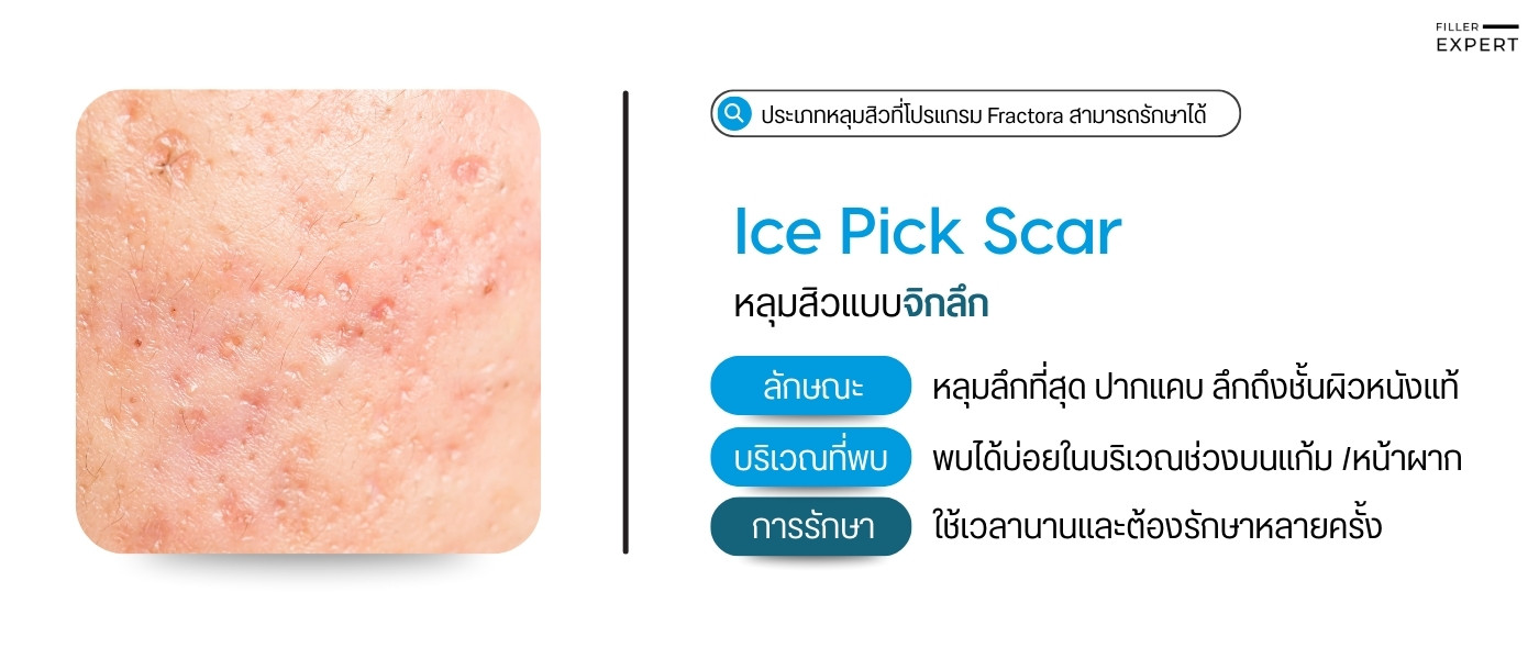 ประเภทหลุมสิวที่ Fractora สามารถรักษาได้ Ice Pick Scar หลุมสิวแบบจิกลึก
