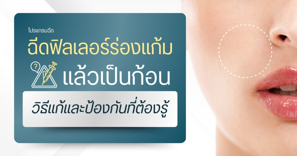 ฉีดฟิลเลอร์ร่องแก้มแล้วเป็นก้อน