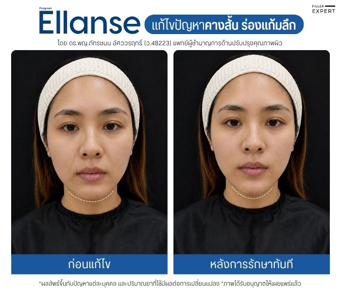 รีวิวผลลัพธ์ Ellanse ร่องแก้ม ร่องน้ำหมาก