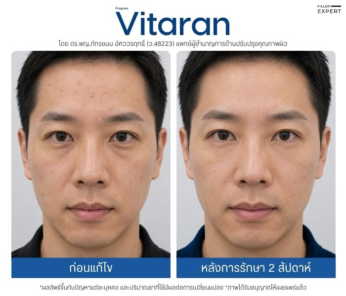รีวิว Vitaran ของกลุ่มผิวเป็นสิว